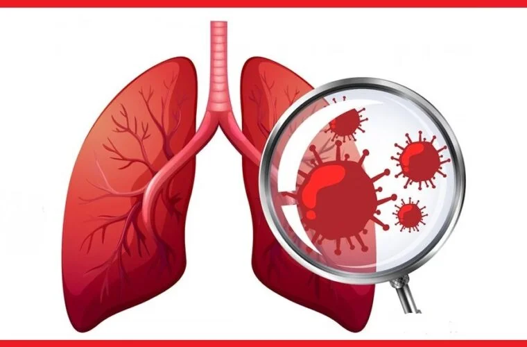 कर्णाली प्रदेशमा ८ सय ६१ क्षयरोगी भेटिए